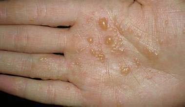 脚痒脱皮起水泡烂脚丫用什么药最好(脚脱皮起泡痒用什么药) 脚痒脱皮起水泡烂脚丫用什么药最好(脚脱皮起泡痒用什么药)