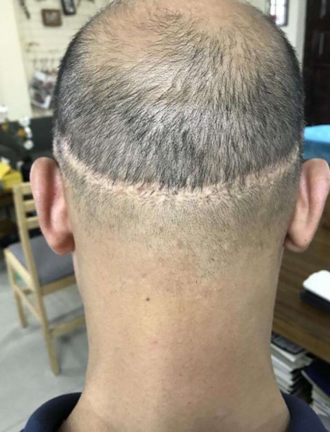 植发有用吗可以维持多久（植发到底有用吗,有的说有用,有的说后悔）