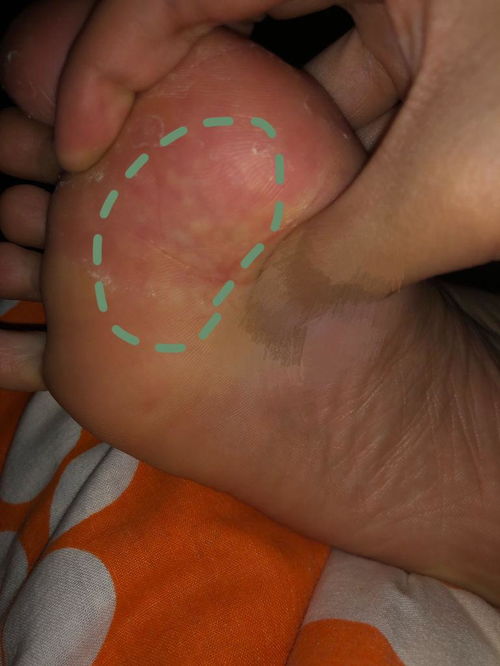 脚底长了像水泡一样的东西很痒是怎么回事（脚底长了像水泡一样的东西很痒痛）