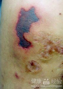 血小板减少性紫癜能根治吗（血小板减少性紫癜严重会怎样）